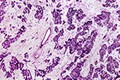Tìm ra cách phát hiện sớm ung thư di căn từ vú sang phổi