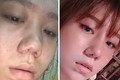 Cô gái tố bị hỏng mũi, trầm cảm sau khi nâng mũi tại thẩm mỹ viện Klain Beauty Center