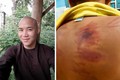 Thân thể bé trai 11 tuổi rướm máu, lở loét vì bị thầy chùa đánh đập dã man