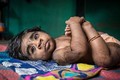 Cậu bé Ấn Độ bị kỳ thị vì lông phủ kín cả cơ thể