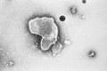 Virus hợp bào hô hấp gây bệnh ở trẻ nguy hiểm sao?