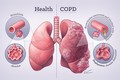 Bệnh phổi tắc nghẽn mạn tính nguy hiểm sao?
