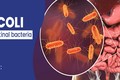Biến chứng chết người khi nhiễm vi khuẩn E.coli