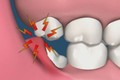 Mẹo giảm đau ngay tức thì khi mọc răng khôn 