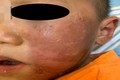 Bác sĩ cảnh báo vụ bé 4 tuổi bỏng rộp da mặt vì hóa trang Halloween