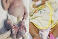 Bé sơ sinh ở Nghệ An mắc bệnh giang mai 