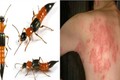 Nọc độc kiến ba khoang nguy hại đến mức nào, dấu hiệu cần đi viện?