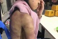 Bé gái 12 tuổi nghi bị bạo hành, xâm hại tình dục: Cục Trẻ em lên tiếng