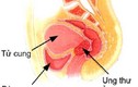 Các cách chăm sóc bệnh nhân ung thư cổ tử cung