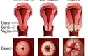 Các biểu hiện thường gặp của bệnh ung thư cổ tử cung