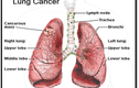 Các loại ung thư phổi thường gặp