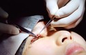 Chùm ảnh “tai nạn” khi phẫu thuật cắt mí mắt