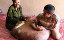 Tâm sự “tuyệt tình” của người có khối u lớn nhất Việt Nam
