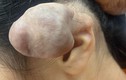 3 lần phẫu thuật u khủng vì bấm 6 lỗ tai cho “chất”