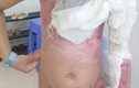 TP HCM: Liên tiếp hai trẻ nhỏ bị bỏng do cồn và xăng