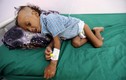 Loạt ảnh nhói lòng về cuộc khủng hoảng nhân đạo ở Yemen