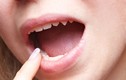 3 dấu hiệu bất thường ở miệng, ung thư lưỡi đến gần