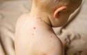 Ca mắc thủy đậu ở trẻ tăng cao: Những biến chứng nguy hiểm