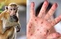 Long An ghi nhận ca mắc bệnh đậu mùa khỉ đầu tiên