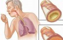 Biểu hiện lạ nguy hiểm trong chữa ung thư phổi