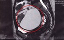 Choáng phát hiện khối u 16cm trong ổ bụng khi đặt vòng tránh thai