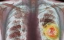 Ung thư phổi xâm nhập, tàn phá cơ thể như thế nào? 
