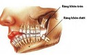 “Răng khôn mọc dại” và những biến chứng chết người 