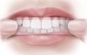Hậu họa khôn lường từ miếng dán trắng tẩy răng