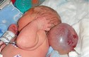 Em bé sinh ra với khối u bóng nước to bằng đầu