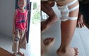 Những trường hợp mổ nhầm chân ở Việt Nam