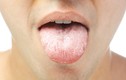 10 vị thuốc tự nhiên chữa dứt bệnh lưỡi trắng