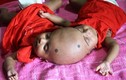 Thương tâm cặp song sinh dính liền đầu ở Bangladesh