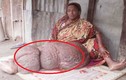 Chân khổng lồ gần 60 kg khiến người phụ nữ liệt suốt 18 năm