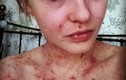 Thiếu nữ chàm eczema "lột xác" nhờ cháo yến mạch