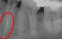 Mũi khoan nha khoa nằm trong răng bệnh nhân suốt 2 năm