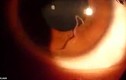 Video khủng khiếp ký sinh trùng ngọ nguậy trong mắt
