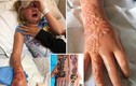 Thương tâm bé gái bị bỏng hóa học nặng do mực xăm henna 