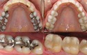 Video: Mẹo thần kì giúp răng sâu mọc trở lại