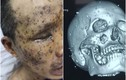Kinh hoàng bệnh nhân ở Quảng Ninh bị cả trăm mảnh kim loại găm vào mặt