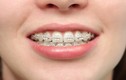 Phương pháp thẩm mỹ răng nào an toàn và được lựa chọn nhiều nhất?