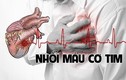 Loạt dấu hiệu nhận biết nhanh của nhồi máu cơ tim