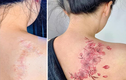 Mê mẩn hình xăm che sẹo của cô gái Việt gây sốt báo ngoại