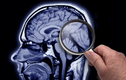 Di chứng hậu COVID-19: Nguy cơ tổn thương não lâu dài
