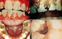 Cận cảnh thuốc lá tàn phá dữ dội sức khỏe răng miệng