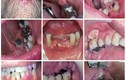 Cận cảnh sự tàn phá khủng khiếp của ung thư miệng