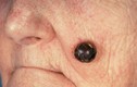 Phát hiện ung thư da từ nốt ruồi đáng ngờ