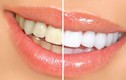 5 bí quyết để có một hàm răng trắng sáng rạng ngời