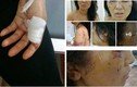Giáo viên tiểu học bị chồng đánh đập dã man rúng động Phú Thọ