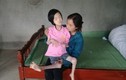 Phú Thọ: Xót thương cháu bé nghèo bị đa dị tật chân tay co quắp
