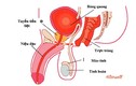 Điều trị ung thư tuyến tiền liệt: lợi bất cập hại